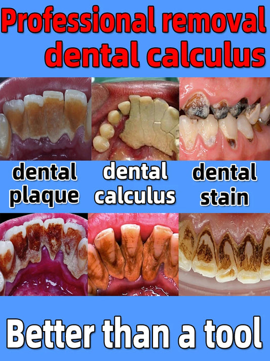 remover dental calculus whitening teeth mouth odor removal bad breath Preventing Periodontitis